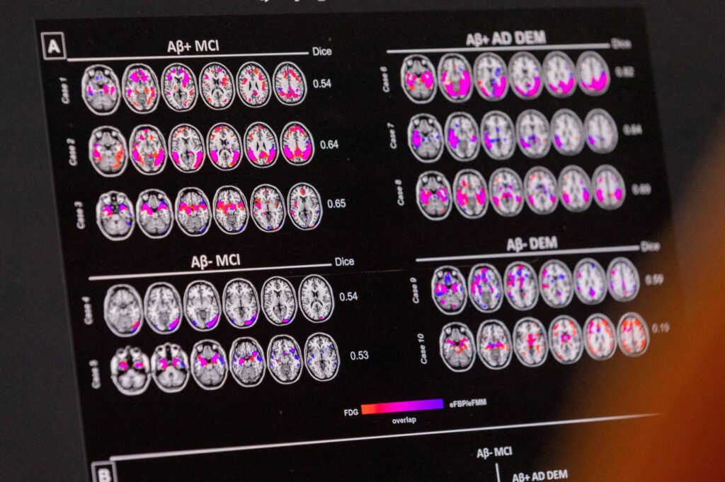 o-que-exames-de-sangue-para-detectar-biomarcadores-de-alzheimer-podem-dizer