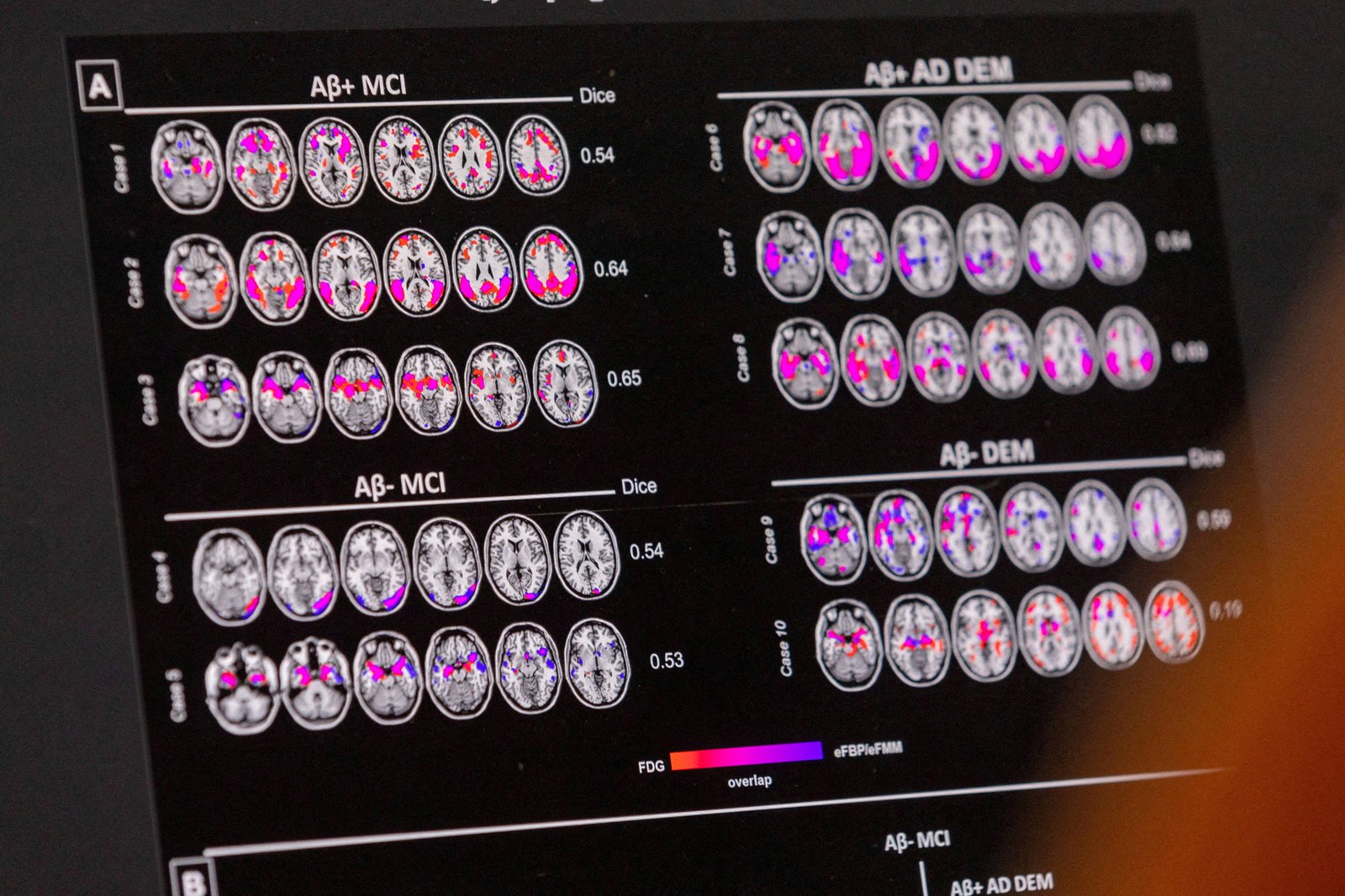 o-que-exames-de-sangue-para-detectar-biomarcadores-de-alzheimer-podem-dizer