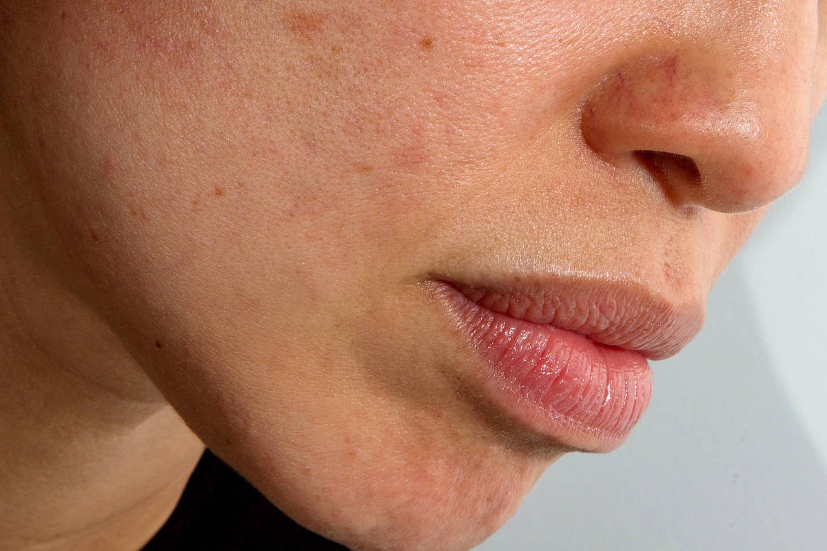 meu-rosto-fica-vermelho-e-corado;-por-que-isso-esta-piorando-com-a-idade?