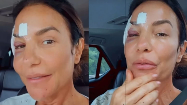 Ivete Sangalo recebe alta hospitalar e explica queda em casa